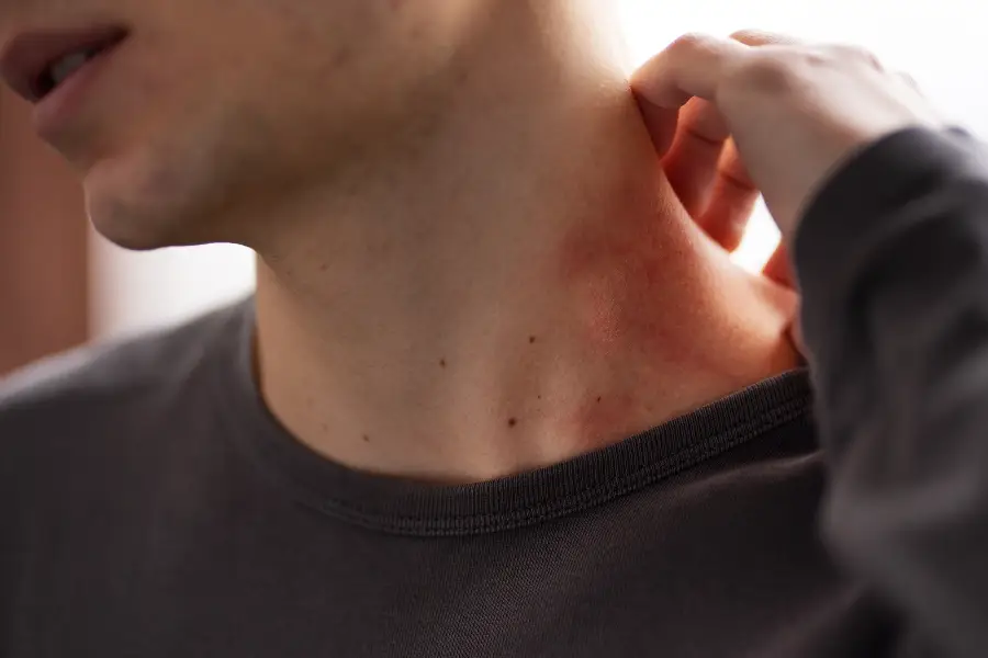 Person dealing with rosacea