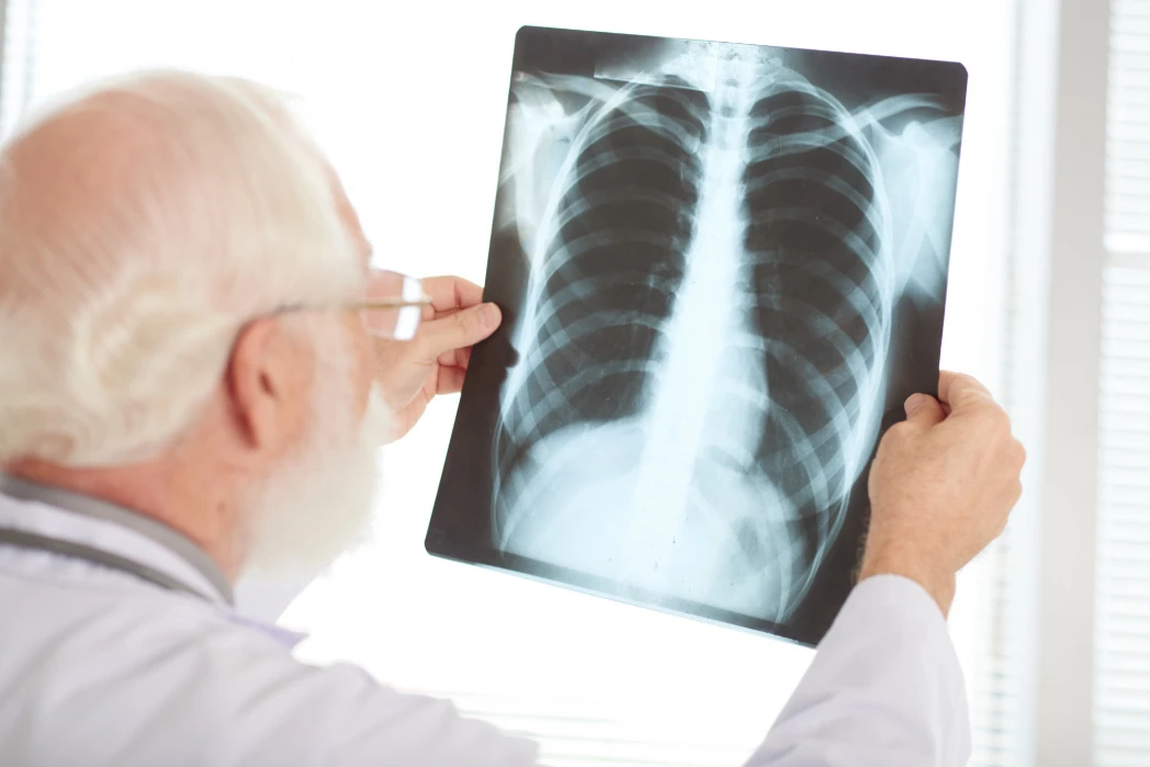 Tuberculosis Image